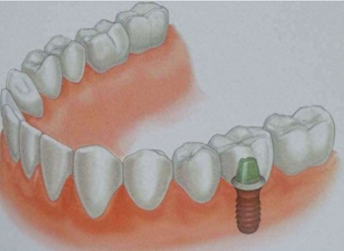 牙齿缺失 成年人种植牙是如何进行的全面解读