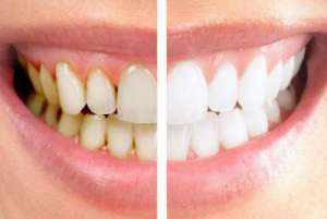 激光美白牙齿的原理、过程、优势以及注意事项