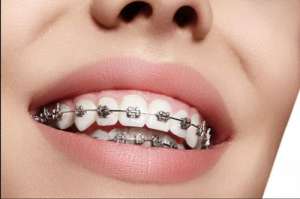 金属矫正牙齿的优缺点全面解析