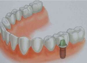 种植牙需要多长时间才能完成手术过程呢？