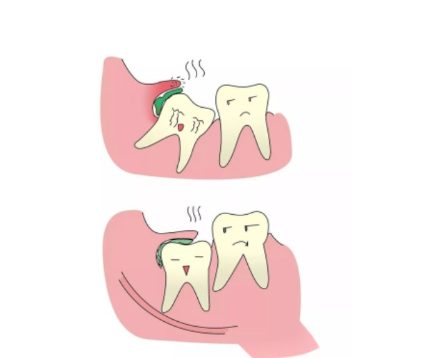 拔智齿和拔普通牙齿哪个疼？