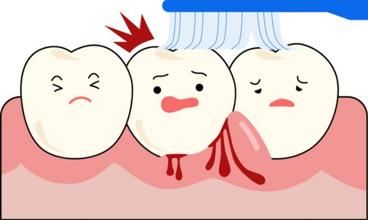 为什么牙龈经常萎缩？