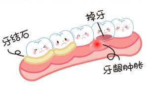 牙齿根管治疗适用于哪些牙齿问题？