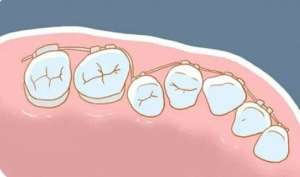 牙齿半隐形矫正需要注意什么？
