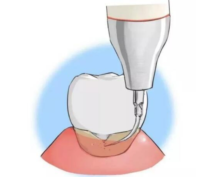 龈下刮治术对牙齿有损伤吗？