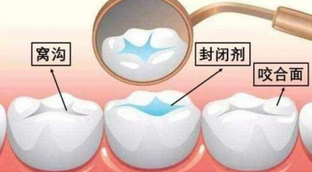 儿童什么时候做窝沟封闭最好？