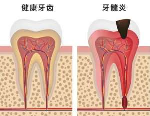 什么是牙髓炎？牙髓炎的治疗方法有哪些？