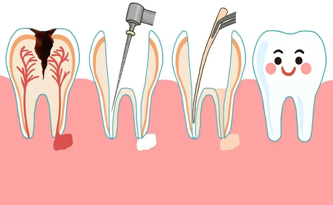 根管治疗后为什么牙齿还疼？