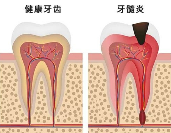 牙髓炎有哪些常见症状？不治疗能自愈吗？