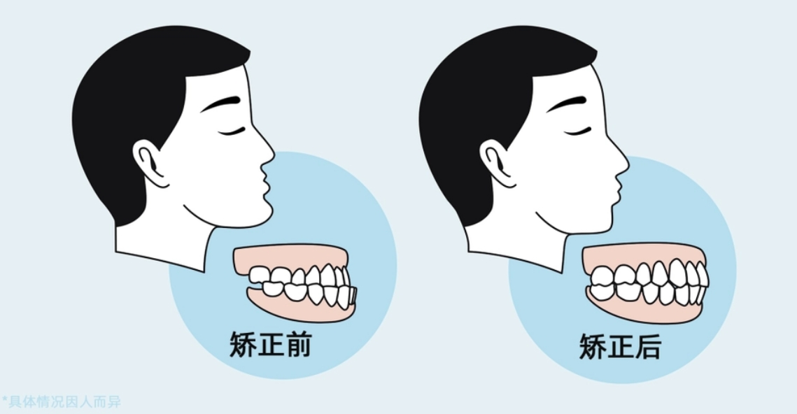 牙齿矫正的适龄期是什么时候？